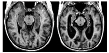 Two MRIs that depict the brain of a person without Alzheimer's, and a person with Alzheimer's.